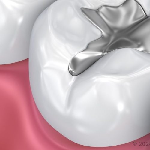 dental fillings