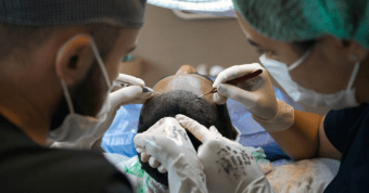 Follicular Unit Extraction