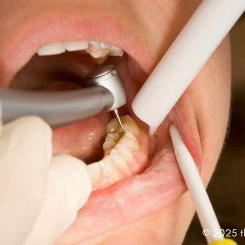 preparing for a dental filling