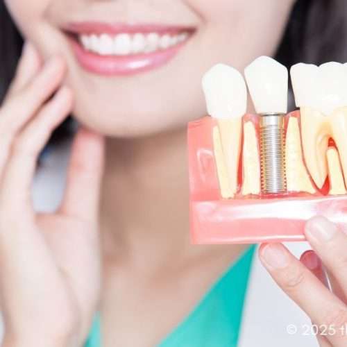 Dental Implant Education