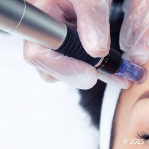 microneedling skin treatments