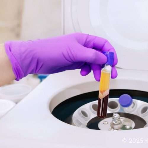PRP Therapy