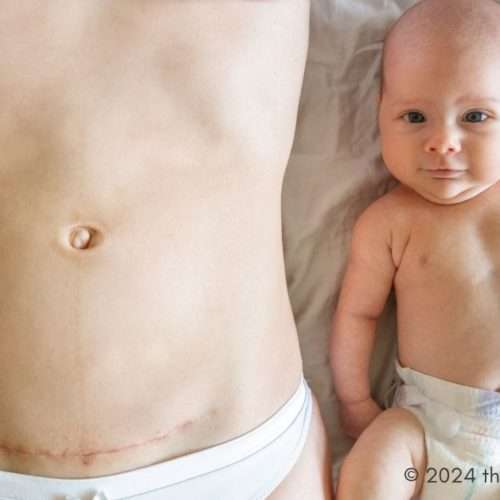 post-baby belly