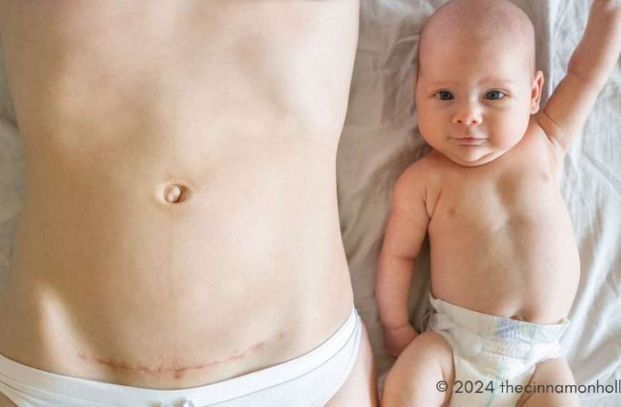 post-baby belly