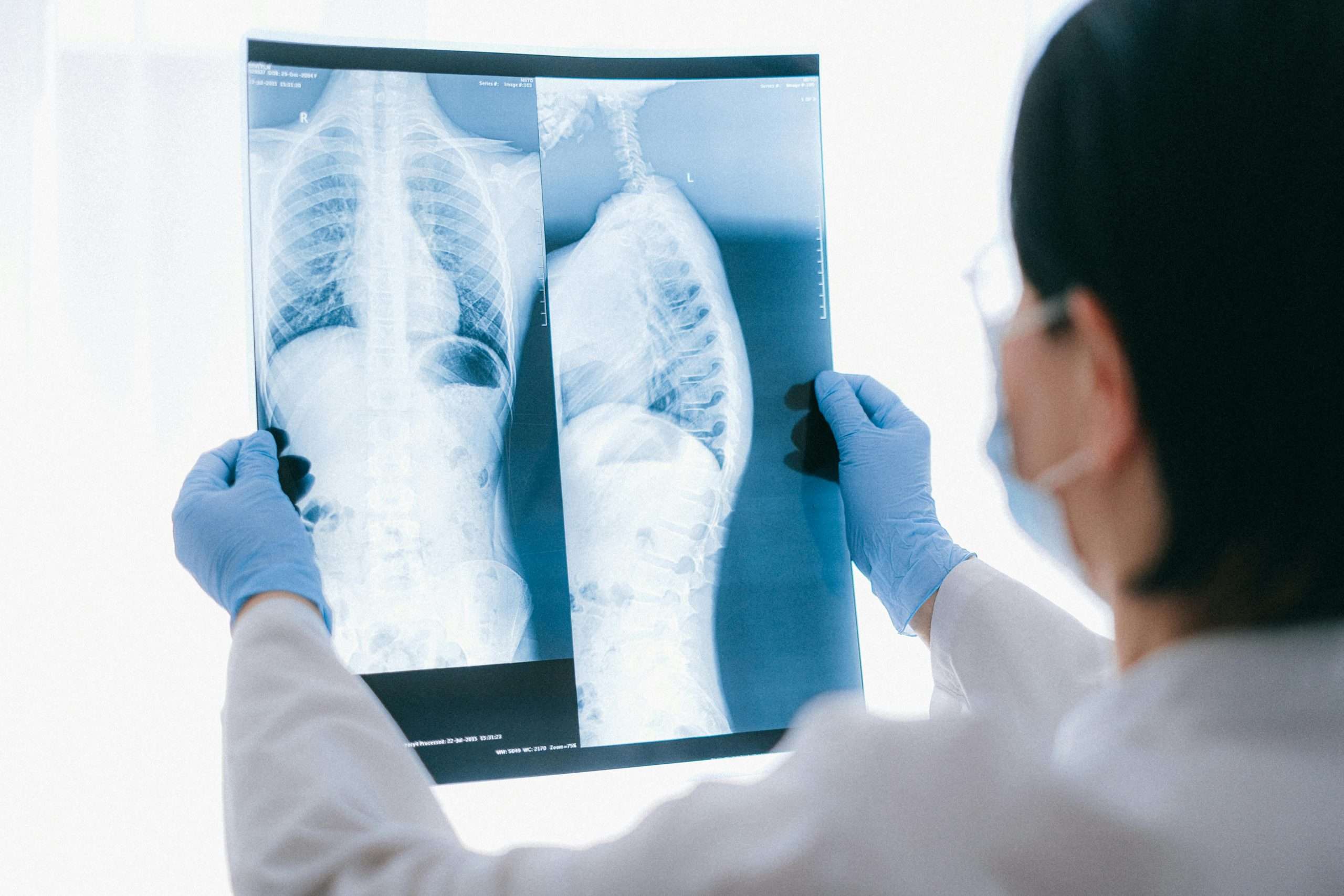 chest x-ray for cough or mesothelioma