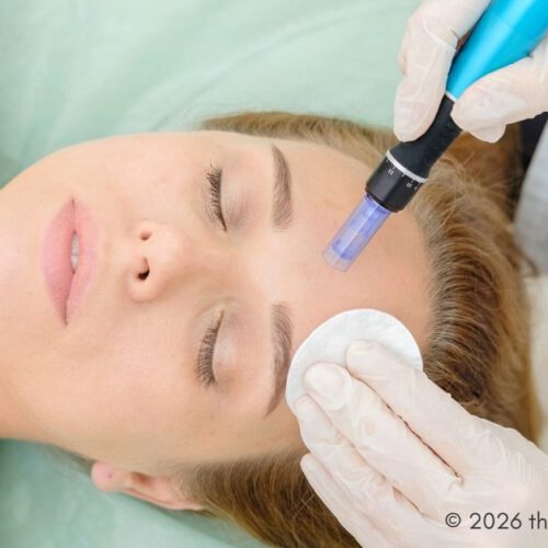 microneedling