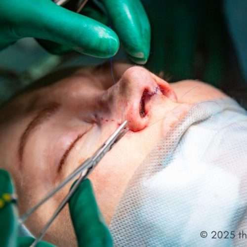 nose surgery