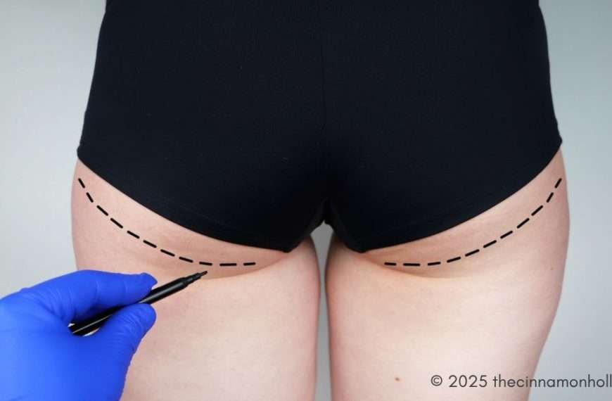 Buttock Augmentation