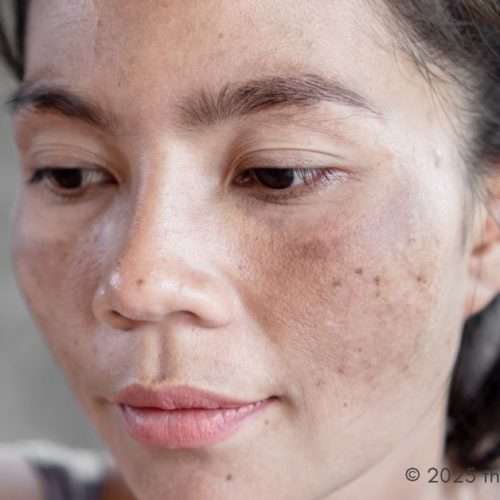 Melasma