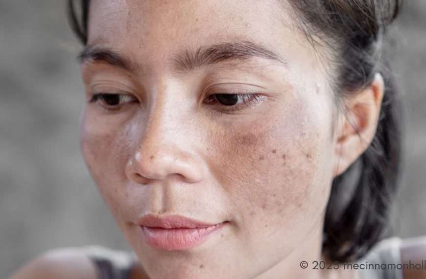 Melasma
