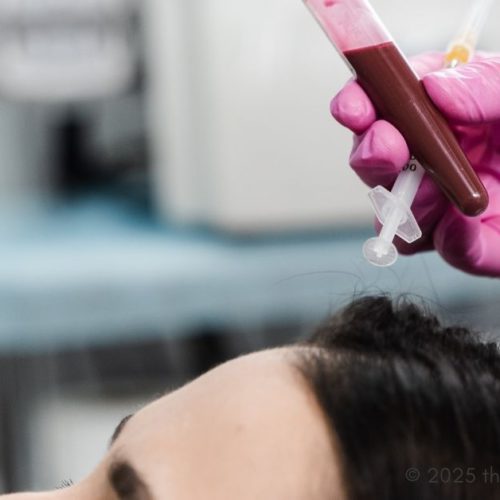 PRP - Platelet-rich plasma treatment