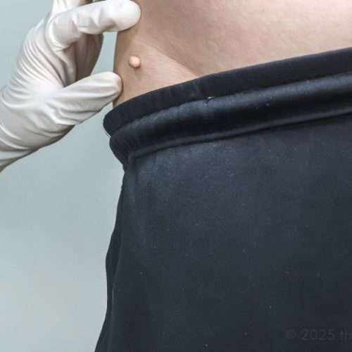 genital skin tags