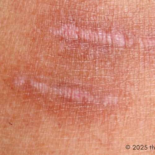 Scars