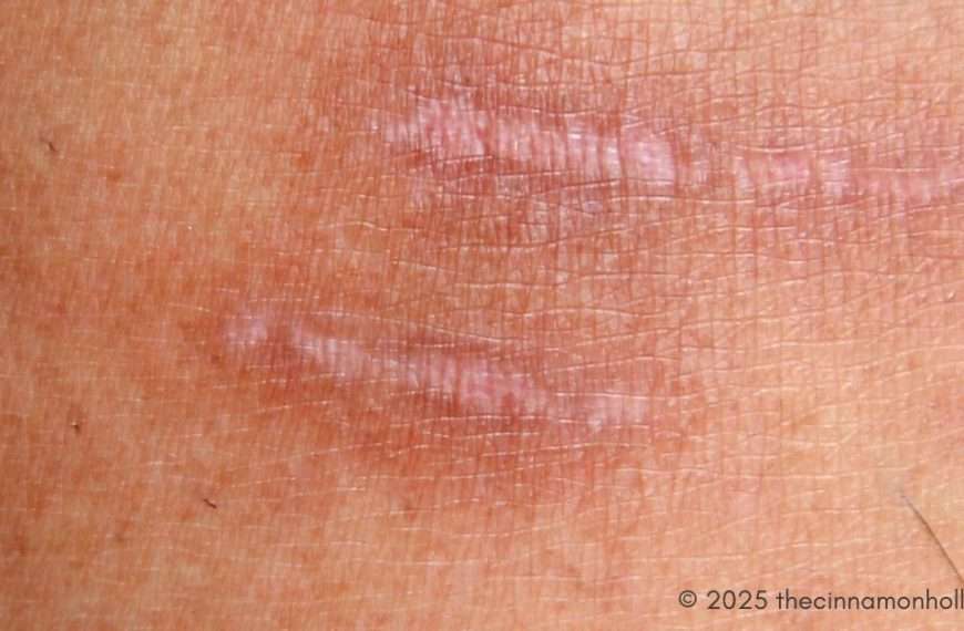 Scars