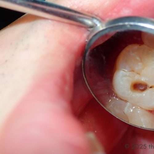 cavities