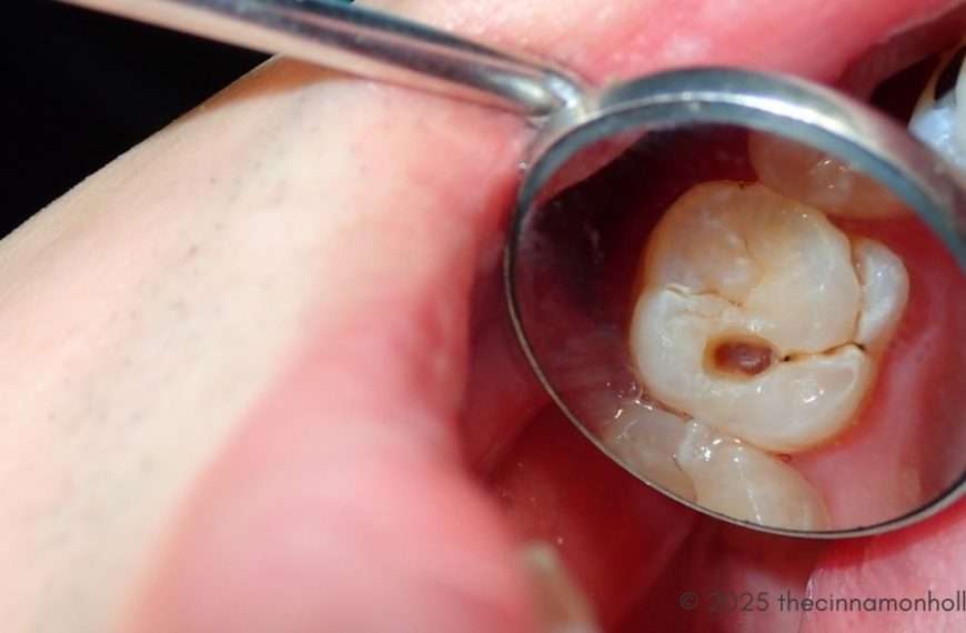 cavities