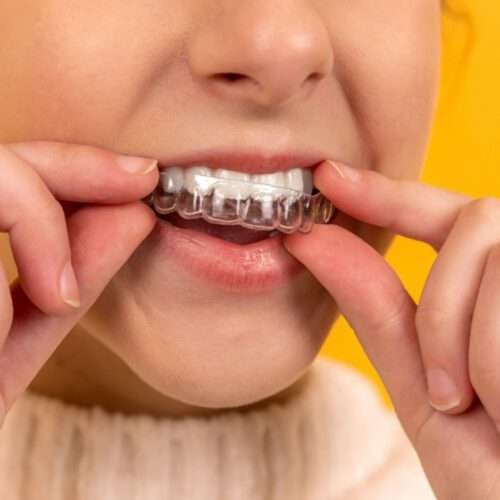 Retainers After Orthodontic Treatment