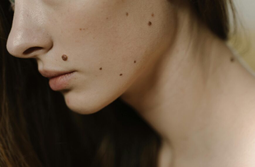 mole removal