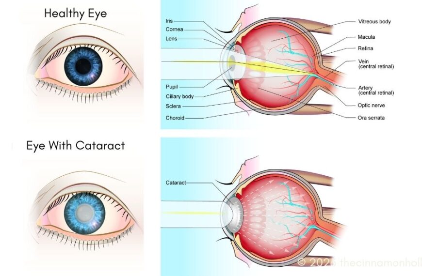 cataract