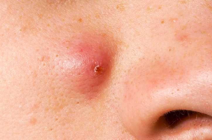 Treat Skin Cyst