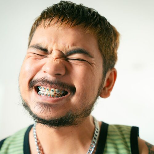 braces for crooked teeth