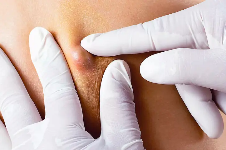 Treat Skin Cyst