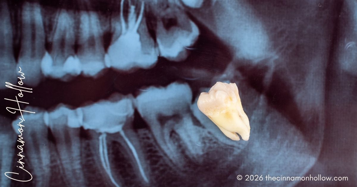 Wisdom Tooth Extraction