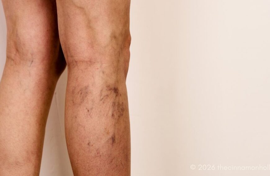 varicose and spider veins