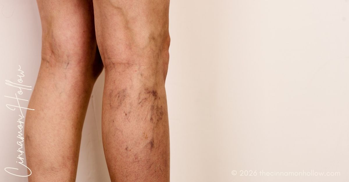 varicose and spider veins