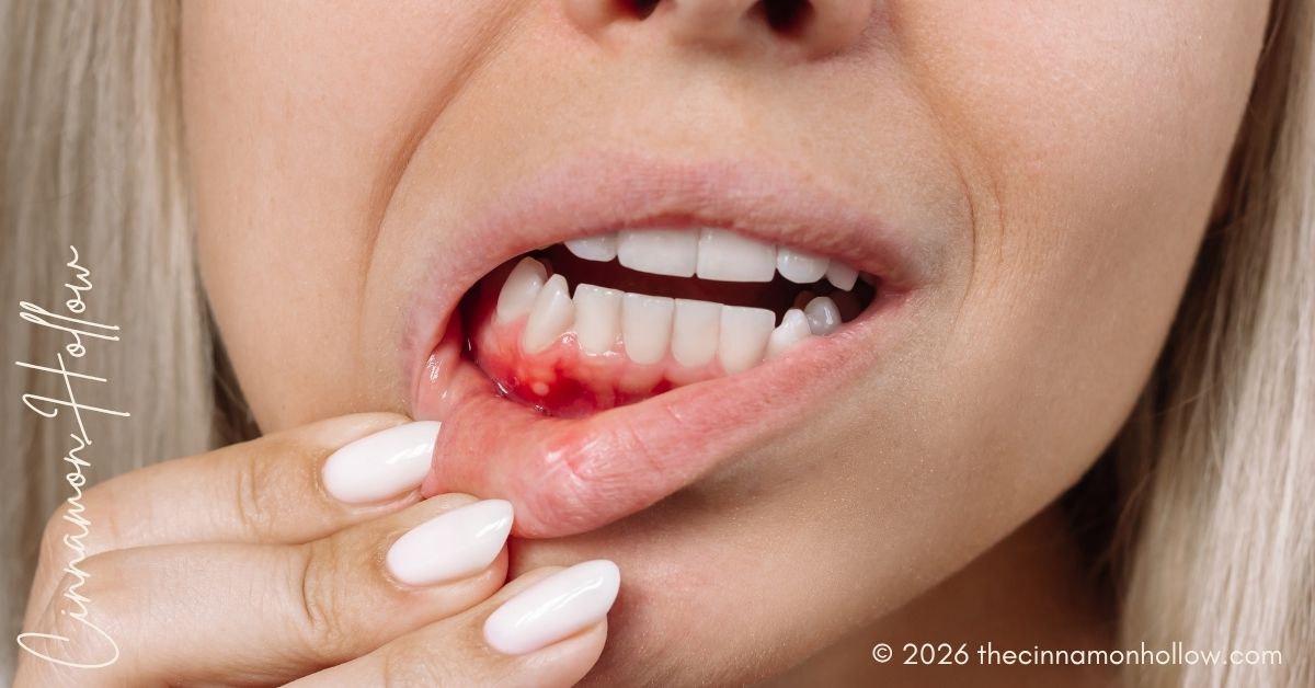 Advanced Gum Infection - LANAP Laser Treatment