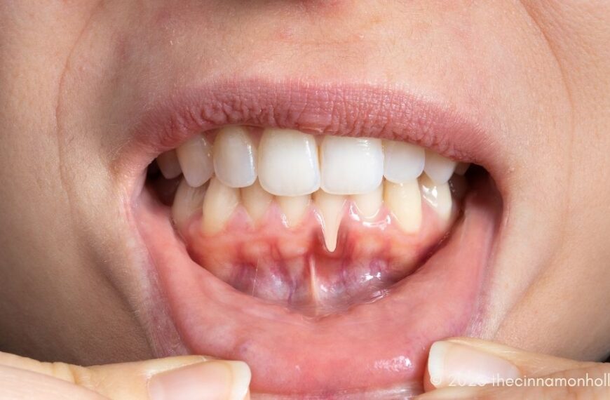 Periodontal Disease