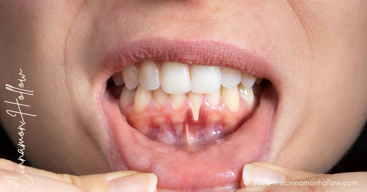 Periodontal Disease